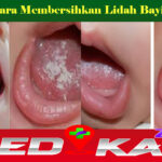 Beginilah Cara Membersihkan Lidah Bayi yang Putih