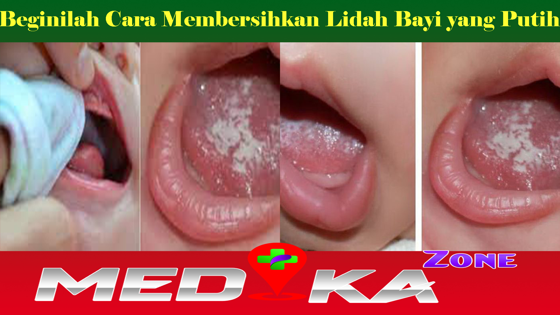 Beginilah Cara Membersihkan Lidah Bayi yang Putih